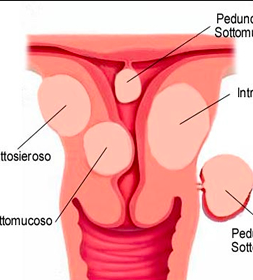 utero antiversoflesso