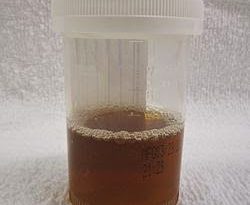 bilirubina-nell-urina