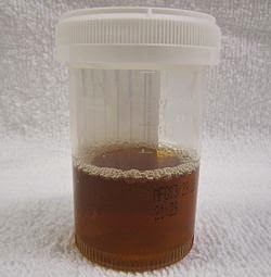bilirubina-nell-urina