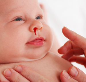 sangue dal naso neonato