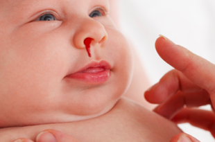 sangue dal naso neonato