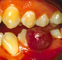 granuloma dentale