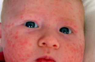 acne neonatale