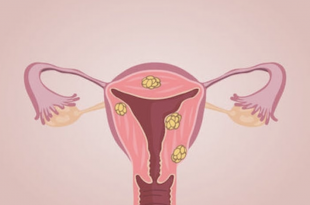 utero fibromatoso
