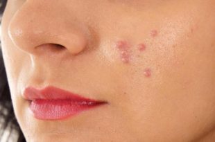 Come gestire il problema dell'acne in gravidanza?